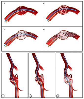 Hemodynamic Comparison of Treatment Strategies for Intracranial Vertebral Artery Fusiform Aneurysms